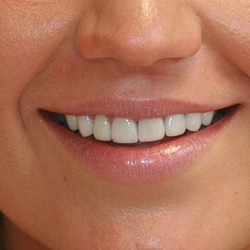 8 ceramic veneers